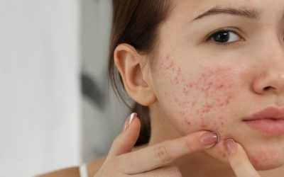 Why You Shouldn’t Attempt to Pop That Pimple Yourself